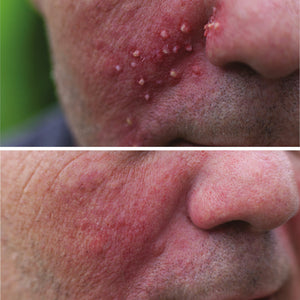 Acne-like skin rash