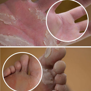Hand-Foot Syndrome image